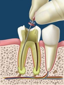 endodoncia11