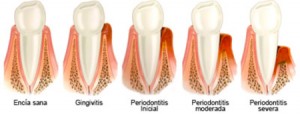 periodontitis